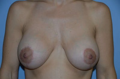 Breast Augmentation Lift Before & After Gallery - Patient 257320 - Image 2