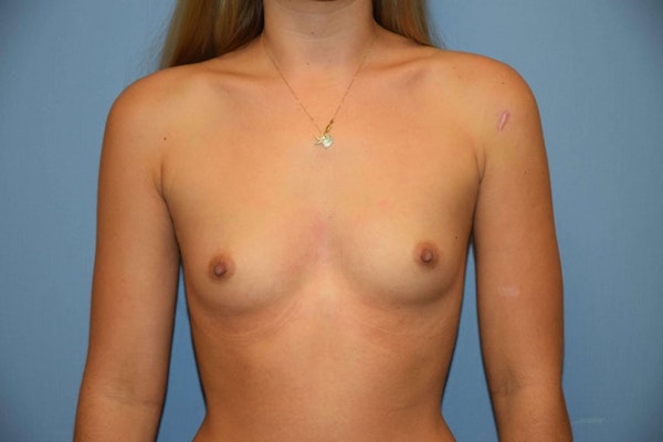 Breast Augmentation Before & After Gallery - Patient 408319 - Image 1