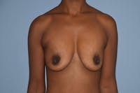 Breast Augmentation Before & After Gallery - Patient 421581 - Image 1
