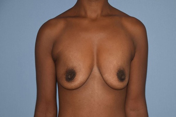 Breast Augmentation Before & After Gallery - Patient 421581 - Image 1