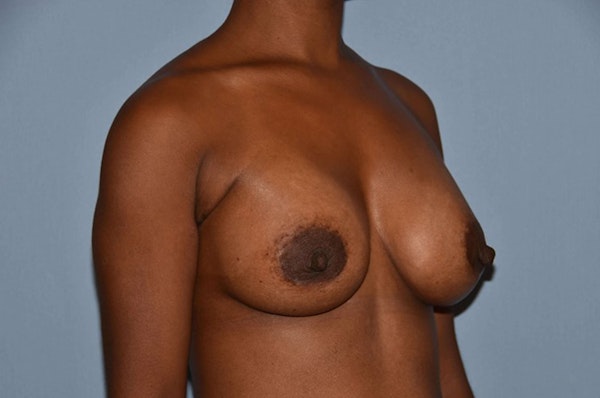 Breast Augmentation Before & After Gallery - Patient 421581 - Image 4