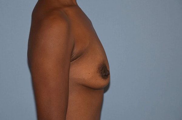 Breast Augmentation Before & After Gallery - Patient 421581 - Image 5