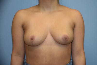 Breast Reduction Before & After Gallery - Patient 406223 - Image 2