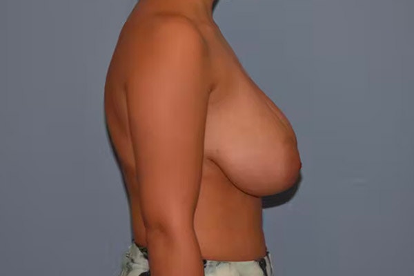 Breast Reduction Before & After Gallery - Patient 406223 - Image 5