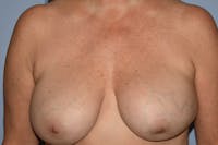 Breast Augmentation Lift Before & After Gallery - Patient 120843 - Image 1