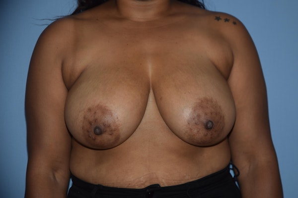 Breast Reduction Before & After Gallery - Patient 250277 - Image 1