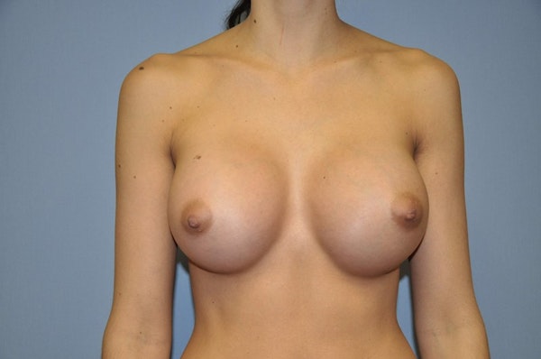 Breast Augmentation Before & After Gallery - Patient 235502 - Image 2
