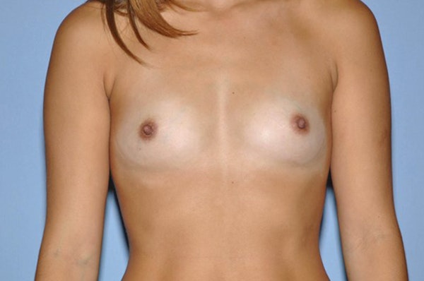 Breast Augmentation Before & After Gallery - Patient 117403 - Image 1