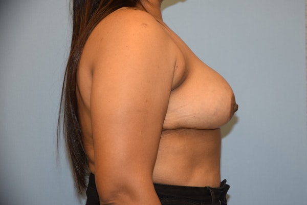Breast Reduction Before & After Gallery - Patient 250277 - Image 6