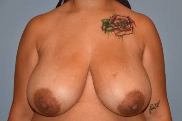 Breast Reduction Before & After Gallery - Patient 108127 - Image 1