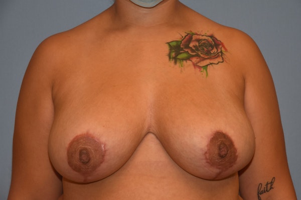 Breast Reduction Before & After Gallery - Patient 108127 - Image 2