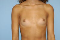 Breast Augmentation Before & After Gallery - Patient 865287 - Image 1