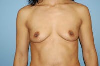 Breast Augmentation Before & After Gallery - Patient 107378 - Image 1