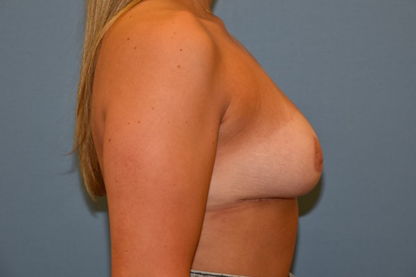 Breast Reduction Before & After Gallery - Patient 138280 - Image 6