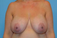 Breast Reduction Before & After Gallery - Patient 520302 - Image 1