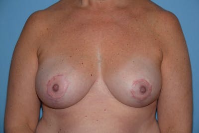 Breast Reduction Before & After Gallery - Patient 520302 - Image 2