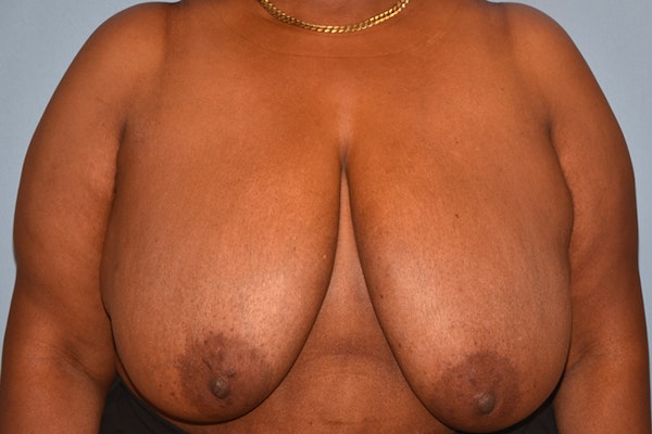 Breast Reduction Before & After Gallery - Patient 222895 - Image 1