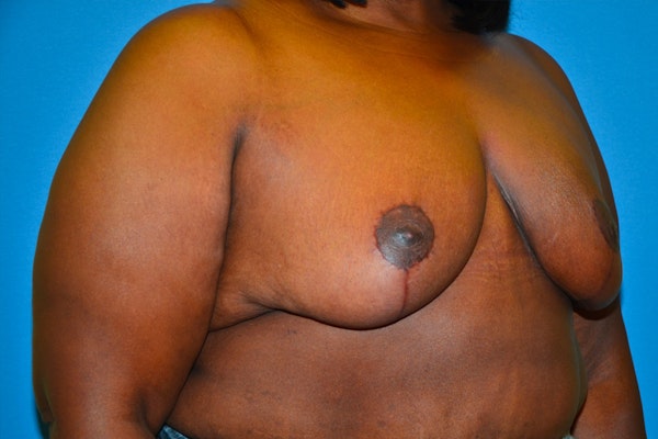 Breast Reduction Before & After Gallery - Patient 222895 - Image 4
