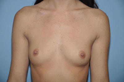 Breast Augmentation Before & After Gallery - Patient 230786 - Image 1