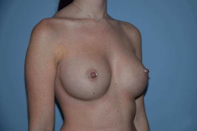 Breast Augmentation Before & After Gallery - Patient 230786 - Image 4