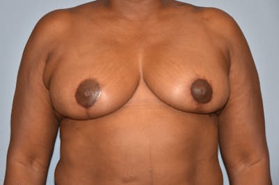 Breast Reduction Before & After Gallery - Patient 374545 - Image 2
