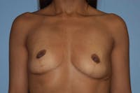 Breast Augmentation Before & After Gallery - Patient 745751 - Image 1
