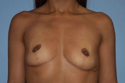 Breast Augmentation Before & After Gallery - Patient 745751 - Image 1