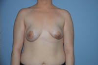 Breast Augmentation Before & After Gallery - Patient 752781 - Image 1
