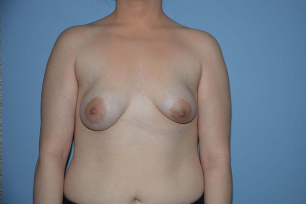 Breast Augmentation Before & After Gallery - Patient 752781 - Image 1