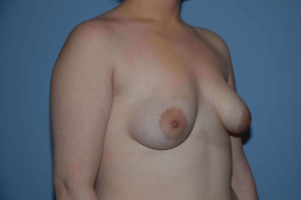 Breast Augmentation Before & After Gallery - Patient 752781 - Image 3