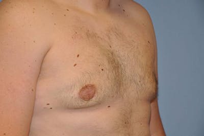 Gynecomastia Before & After Gallery - Patient 109874 - Image 4