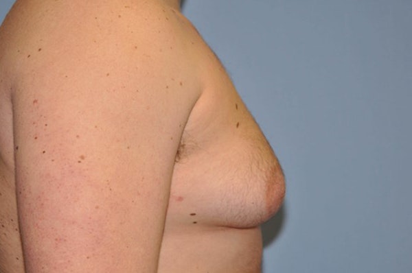 Gynecomastia Before & After Gallery - Patient 109874 - Image 5