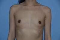 Breast Augmentation Before & After Gallery - Patient 401311 - Image 1