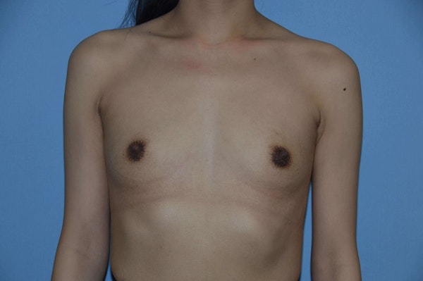 Breast Augmentation Before & After Gallery - Patient 401311 - Image 1