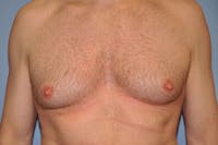Gynecomastia Before & After Gallery - Patient 353276 - Image 1