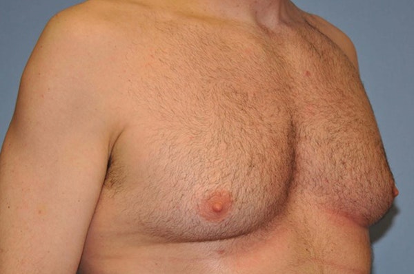 Gynecomastia Before & After Gallery - Patient 353276 - Image 3