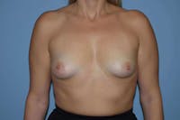 Breast Augmentation Before & After Gallery - Patient 337918 - Image 1