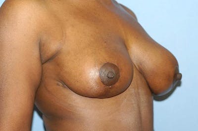 Breast Reduction Before & After Gallery - Patient 318724 - Image 4