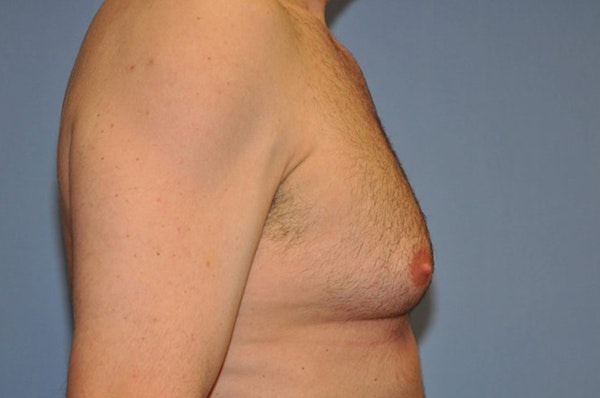 Gynecomastia Before & After Gallery - Patient 353276 - Image 5