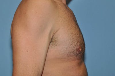 Gynecomastia Before & After Gallery - Patient 353276 - Image 6