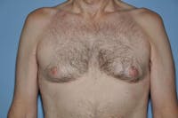Gynecomastia Before & After Gallery - Patient 822347 - Image 1