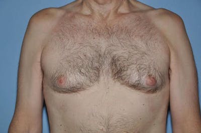 Gynecomastia Before & After Gallery - Patient 822347 - Image 1