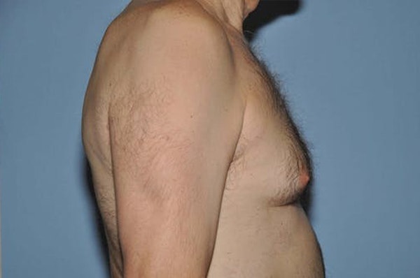 Gynecomastia Before & After Gallery - Patient 822347 - Image 3