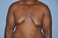 Gynecomastia Before & After Gallery - Patient 306025 - Image 1