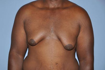Gynecomastia Before & After Gallery - Patient 306025 - Image 1