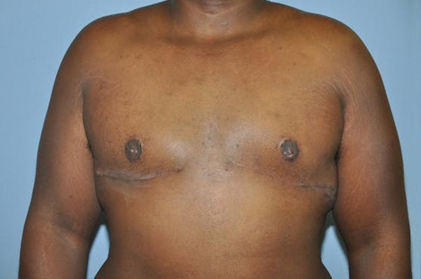 Gynecomastia Before & After Gallery - Patient 306025 - Image 2