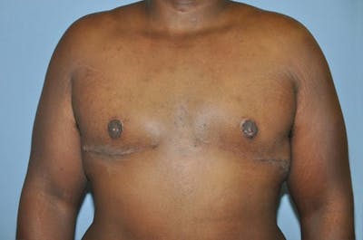 Gynecomastia Before & After Gallery - Patient 306025 - Image 2