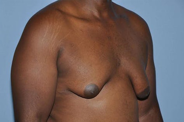 Gynecomastia Before & After Gallery - Patient 306025 - Image 3