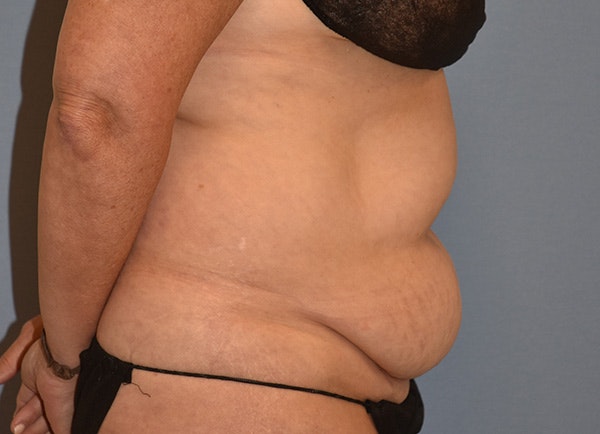Tummy Tuck Before & After Gallery - Patient 120913 - Image 3