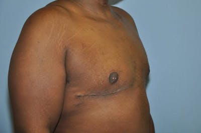 Gynecomastia Before & After Gallery - Patient 306025 - Image 4